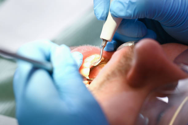Best Emergency Wisdom Teeth Removal in Rock Springs, WY