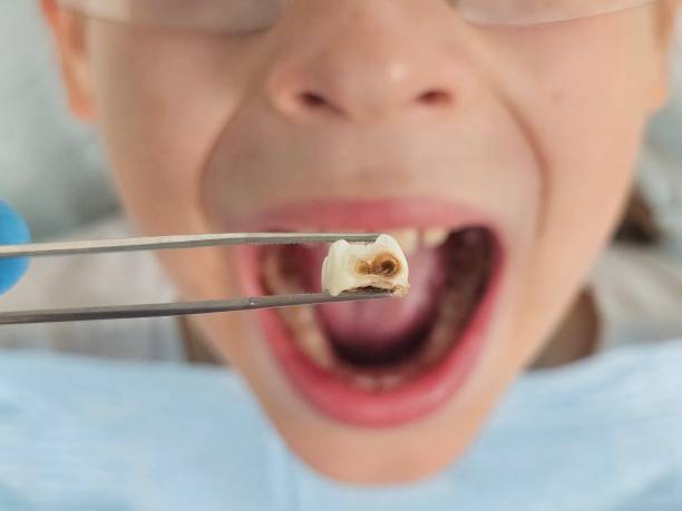 Best Emergency Treatment for Toothache in Rock Springs, WY