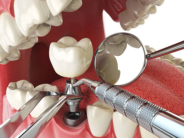 Best Emergency Root Canal Treatment in Rock Springs, WY
